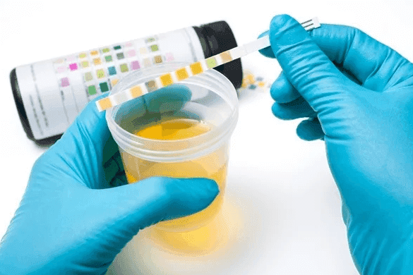 Urine Analysis
